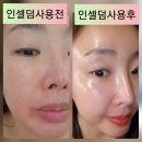 인셀덤 투게더 | 인셀덤사용후기