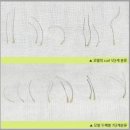 [MBC이코노미뉴스]리폼 커플링(reform coupling)헤어라인 교정 수술 이미지