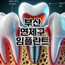 유앤아이치과병원 | 부산 연제구 임플란트 가격 저렴한 곳 위치와 리스트