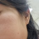 샤인유의원 건대점 스타워커 여드름색소침착 레이져5회결제후 1회차 후기