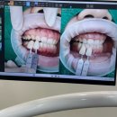 평택뉴욕치과의원 | [약속플러스치과] 평택 지제역 근처 치과 추천 / 미백 1회 후기