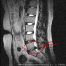 -허리디스크 치료사례 -13 황인동님편-(요추4-5번 및 요추 5-천추1번추간판 탈출증) 이미지