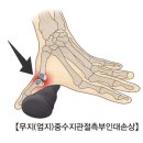 무지(엄지)중수지관절측부인대손상(Gamekeeper's thumb) 근골격 질환이란? 이미지