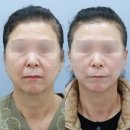 플래닛성형외과의원 | 가격? 비싸면 잘할 거란 안일한 착각 [병원, 성형외과, 잘하는곳, 추천, 비용, 후기, 부작용, 회복기간]