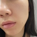 나성동피부과 30대 관리데이 슈링크유니버스후기 (효과, 붓기, 내돈내산)