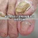모든의료기(통상) | 용답역 문제성발톱 전문 풋풋한리쌤(어르신 후기)
