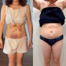 멍블링 | [복부지방추출주사] 시술 당일부터 7일차까지 후기