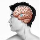 "AI로 파킨슨병 환자 뇌심부자극술 결과 예측 가능" 이미지