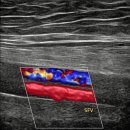 심외과의원 | 두 부위 (목, 다리) 동시 시술 성공 스토리 <3시간 고난도 인터벤션 시술 후기>