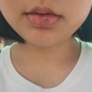 하얀나라린피부과의원 | 입술 사마귀 치료 일지 1