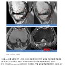 무릎 슬개골 연골연화증, 지방줄기세포 PRP 연골재생으로 치료…세계최초 이미지