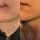 영등포 여드름흉터 한의원 치료 패인 자국 없애는법
