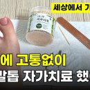 이렇게 하면 내성발톱 바로 치료됩니다. ㅣ 집에서 0원으로 내성발톱 셀프 교정 이미지