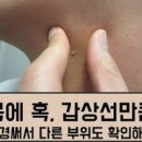 갑상선암 초기증상 ＜갑상선에 좋은 음식＞ 이런 음식은 좋지 않아요 이미지