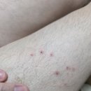 D+298 가려움증(피부사진). 정상수치유지. 이미지