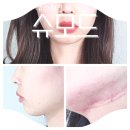멍슈 | [리뷰] &#39;내돈내산&#39; 이중턱 인모드 &amp; 슈링크 &#39;슈모드&#39; 통증, 멍, 효과 후기