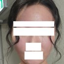 1-1-1.5 | 셀프 오토 MTS 4회차 일주일 후기｜42핀→16핀 바꾸니 모공·흉터에 변화가? (1mm+1.5mm)