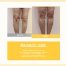 경화반점 이미지