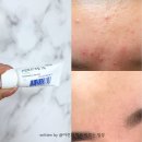 나이스리치(주) | 주사피부염 수란트라 10일차 후기 | 붉은기•농포 변화