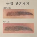 소답동213 | 창원 소답동 눈썹 잔흔 제거/마산 눈썹 잔흔 제거/창원 팔용동 잔흔 제거