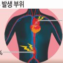 전조증상 없이 터질 수 있는 복부대동맥류 이미지
