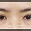 강구외과의원 | 쌍수재수술후기 붓기는 어느정도?