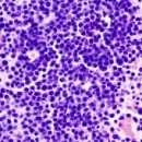 다발성 골수종 (Multiple Myeloma) 이미지