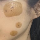 더뺌의원 | 청담 피부과 추천 - 청담르벨의원 흑자 잡티 제거 후기