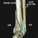 뼈 골절, 원위 경비골 골절 (Distal tibiofibular fracture) 금속판을 이용한 수술 방법 (김한주 원장)
