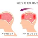 가벼운 뇌진탕 초기 원인 검사와 후유증 이미지