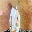 남성반점 이미지