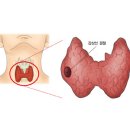 갑상선 수질암 (Medullary thyroid cancer) 이미지