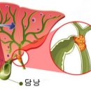 담도암, 가장 나쁜 생활 습관은? 이미지