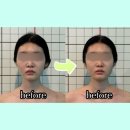 진메디컬 | 강남 윤곽관리 잘하는 곳 추천! 웰본페이스 &amp; 바디메디컬 테라피 방문 후기