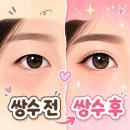 없음 | 40대 쌍수 재수술 절개 후기 (정보없음)