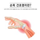 한양류마디병원 | 손목 건초염 통증 원인을 모르니 물리치료 받아도 소용없더라고요(부산 기장 정형외과 한양류마디병원)