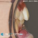 서울클리어치과교정과치과의원 | 고덕동 교정 치과 인비절라인 퍼스트를 활용한 영구치 맹출 공간 확보 및 돌출 개선 사례