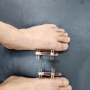 강남챔피언 정형외과 (거여동) 단지증과 우렁발톱 수술후기2탄