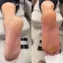 달리자병원 | 파주 운정 발 관리 후기, 남편 발 각질 케어 받고 온 솔직 후기 '스페이스 뷰티'
