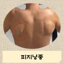 유지방의원 | 피부에 나는 혹 양성종양 피지 낭종 수술 후기 [천안 유지방 의원]