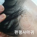 노들담한의원 | 얼굴 편평사마귀 제거 효과있는 방법부터 관리 꿀팁 (내돈내산)