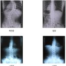 Muscle&Spine) 척추측만증 치료방법 & 진단법 이미지