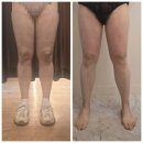 세종바이오 | 허벅지 지방흡입 후관리 받고 바이오본드 풀린 후기(전후비교) - 세종 조치원 바비뷰티