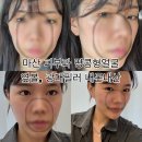 KT마산지점앞 | 창원 마산 피부과 땅콩형얼굴 옆볼필러 5cc 내돈내산 후기