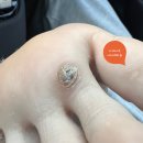 미소지움피부과의원 | 인천송도)사마귀 냉동치료 후기