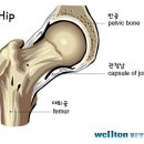 [고관절인공관절수술] 고관절인공관절 수술 잘하는곳, 고관절 수술에 대해 알아볼까요? 이미지