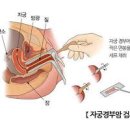 자궁경부암 검사 반응성 세포 HPV 자궁이형성증 이미지