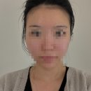GS25 논현송천 | 신논현 캐롤뷰티 | 시그니처 윤곽관리 받고 얼굴 비대칭 개선 찐후기