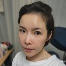 고우리 | 팔자주름 콜라겐 스킨부스터 안산고잔동피부과 고우리부스터 후기