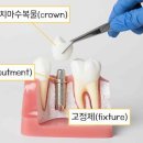 오래오래 튼튼하게 틀니&임플란트의 모든 것 이미지